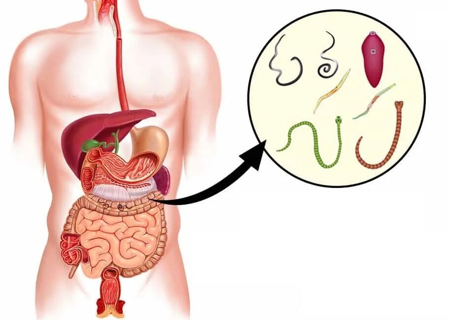 Το Vermixin βοηθά με τους περισσότερους τύπους ελμινθών